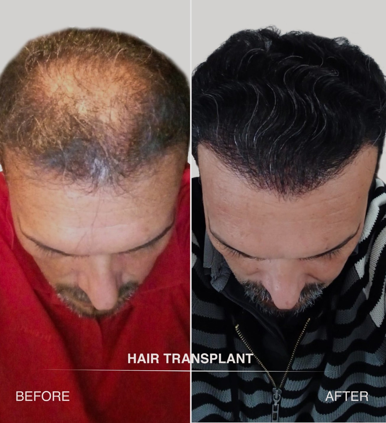 Resultaat 1 haartransplantatie