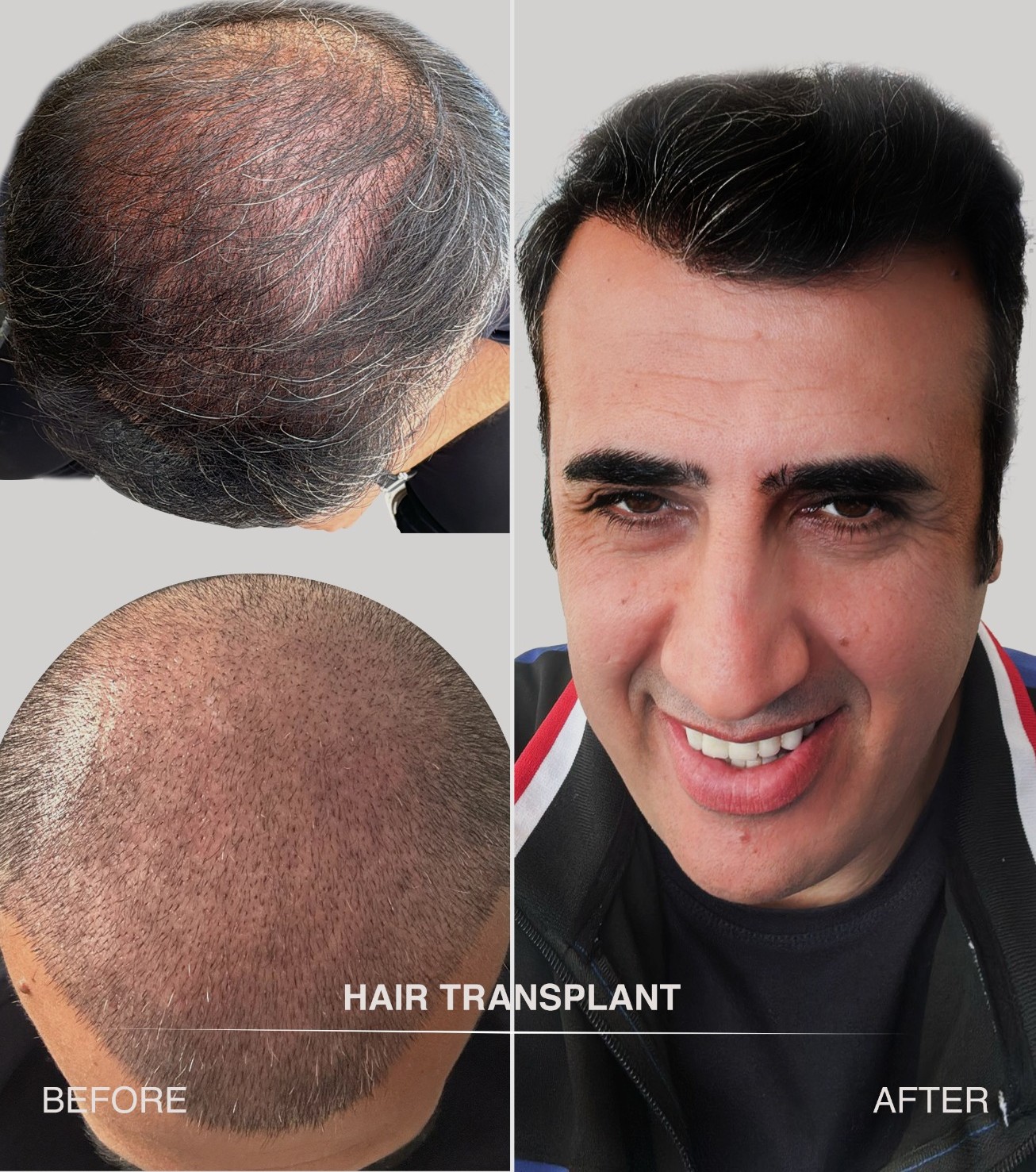 Resultaat 2 haartransplantatie