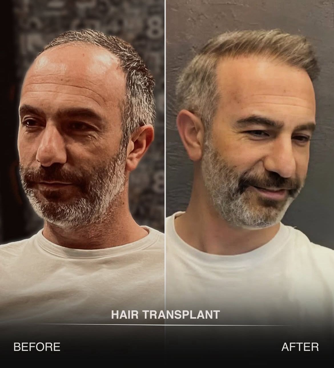 Resultaat 4 haartransplantatie
