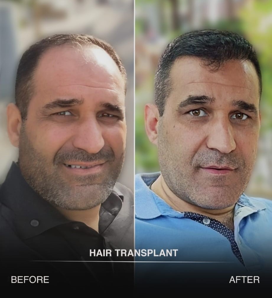 Resultaat 5 haartransplantatie